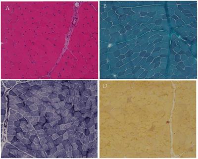 Myotonia Congenita: Clinical Characteristic and Mutation Spectrum of CLCN1 in Chinese Patients